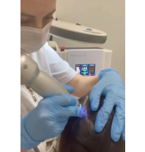Стимуляция роста волос с помощью микроигольчатой радиочастотной терапии ScarLet RF